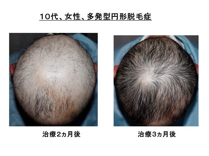 汎発性脱毛　病院